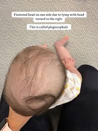 متى يجب القلق من شكل رأس الرضيع والتدخل الطبي؟