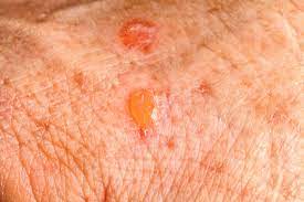 It is a specialized type of actininc. Skin Cancer And Rashes Cancerous And Precancerous Lesions