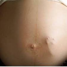 Nach dem eisprung führt ein erhöhter progesteronspiegel dazu, dass der zervixschleim schnell austrocknet. Sieht Man Sowas Wirklich Wenn Man Schwanger Ist Baby