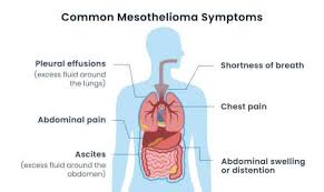 This disease primarily affects people above the age of 65 years old and is more. Mesothelioma Cancer Symptoms Early Warning Signs