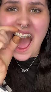 Her Tooth Fell Out?!😅😬🦷 #fyp #teeth #dentistry #braces #health #reaction