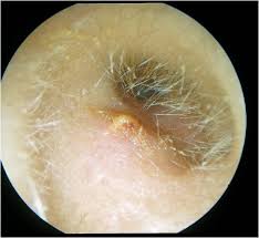 Image result for Acute Otitis Externa