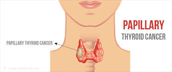 Learn about the symptoms, causes and treatment options in the thyroid cancer condition guide at u.s. Papillary Thyroid Cancer Types Risk Factors Diagnosis Treatment