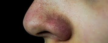 Kita bisa melakukan beberapa cara menghilangkan rasa ngantuk di bawah ini untuk melawannya. 6 Cara Jitu Menghilangkan Jerawat Whitehead Komedo Putih Di Hidung Wartatangerang Com