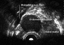 Vaginaler ultraschall hat einen klinischen wert bei der diagnose von endometriomen und vor der. Endometriose Wunschkinder Net