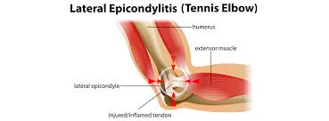 Tennis elbow does not usually lead to serious problems. Tennis Elbow Overview Nonsurgical Treatments