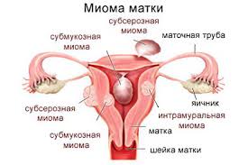 Mereka biasanya memiliki warna yang sama dengan kulit, tetapi mereka dapat berpigmen juga. Fibroid Rahim Apa Itu Mengapa Ia Berbahaya Bagaimana Merawat Punca Gejala Penyakit Dan Diagnosis 2021