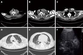 Detection of suspicious lymph nodes: Misdiagnosis Of Left Supraclavicular Lymph Node Metastasis Of Hepatocellular Carcinoma A Case Report