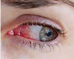 This happens due to an insufficient amount of oxygen. Those Bloodshot Eyes When To See The Doctor Chang Eye Group Call Us Today 412 429 2020