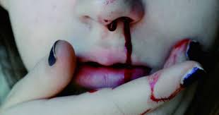 Gerun tengok hidung anak kerap berdarah, pakar kongsi punca & cara merawatnya di rumah. Doktor Ini Kongsi 10 Sebab Mengapa Hidung Berdarah Dengan Kerap Walaupun Fizikal Kelihatan Sihat