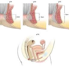 Klikk på dem og velg. Endetarmskreft Store Medisinske Leksikon