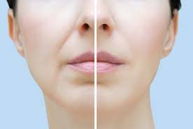 They stretch from the bottom of your nose to the corners of your mouth. Using Juvederm To Treat Nasolabial Folds