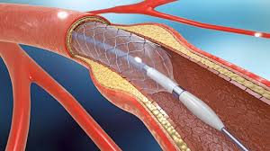 A deflected route usually around a town. Im Zweifelsfall Bypass Diabetiker Niedersachsen E V