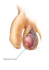 Symptoms may include a lump in the testicle, or swelling or pain in the scrotum. Testicular Cancer The Role Of Self Examination And Ultrasound Andrology Awareness Europe