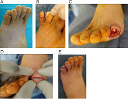 Image result for toe amputation