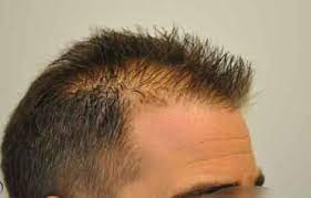 La calvizie negli uomini può comparire fin dai 16 anni · vero · tagliare spesso i capelli contribuisce a rafforzarli e quindi a fermare la caduta . Diradamento Frontale Cosa Fare Che Funzioni Veramente Salute News