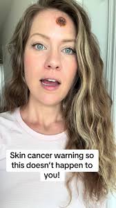 Consejos para prevenir el cáncer de piel