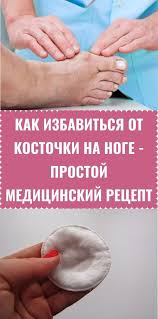 можно ли избавиться от косточки на ноге без операции Pin Na Doske Health