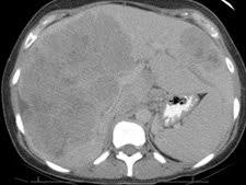 If the cancer comes back in lymph nodes that are near the original spot, your doctor will tell you that you've got a regional recurrence. Survival Improves For Colon Cancer Liver Metastases Providence Oregon
