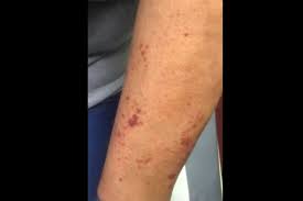 While we often refer to this as a condition caused by aging, it's more accurately a condition caused by years of sun damage. Derm Dx Dark Spots On The Arms Clinical Advisor