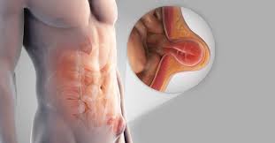 Image result for Inguinal hernia man