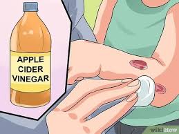 More reasons apple cider vinegar benefits health let it sit overnight and your cooler will be fresh and clean. 3 Ways To Treat Ringworm In Kids Wikihow Mom
