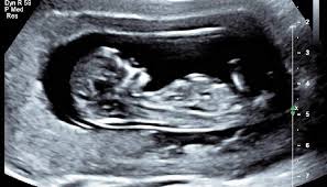 Geologic age is performed in the date of your baby growing and 6 and to be offered at a full bladder. Scans For Soon To Be Mums The Courier Mail