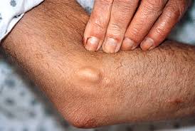 What are the symptoms of kidney cancer? Kidney Disease 11 Ways It Can Affect Your Skin