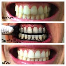 If you want to know how to whiten dentures easily at home, then give this this is a very old practice of cleaning teeth and it also works effectively for cleaning dentures. See How To Whiten Your Teeth At Home In Just A Few Days Face Of Malawi