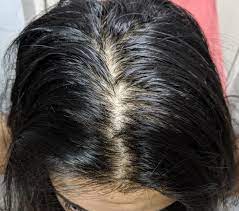 Thinning hair is just a part of getting oldercredit: I M A Woman And I M Losing My Hair Can You Help Me Wrassman M D Baldingblog