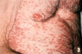 Der erreger wird durch speichelkontakt übertragen, was der krankheit ihren. Arzneimittelinduzierte Hautreaktionen Deximed