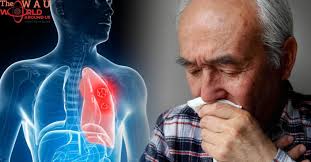 The most common symptoms of lung cancer are: Lung Cancer Symptoms If This Happens To Your Fingers You Could Have The Deadly Disease
