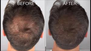In a spray bottle, mix: Will Apple Cider Vinegar Stop Hair Loss Youtube