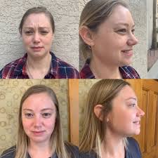 And her answer to my concern was far from what i expected: Botox And Fillers For Facial Pain Smiles Iowa