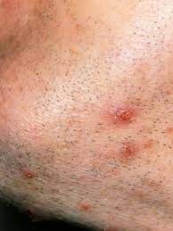 Boils are unpleasant, but fortunately they can usually be prevented! What Is That Skin Growth Skin And Beauty Center Everyday Health