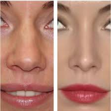 Nose Job To Fix Bulbous Nose Rhinoplasty Cost Pics Reviews Qa In 2020 Rhinoplasty Cost Nose Job Nose Surgery Rhinoplasty