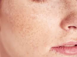 Image result for Freckled skin