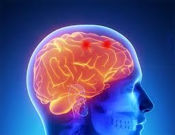 Debido a que un aneurisma cerebral intacto a menudo no causa ningún síntoma. Embolizacion De Aneurismas Cerebrales Geni Grupo Espanol De Neurorradiologia Intervencionista