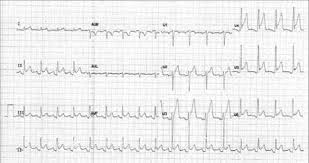 Pericarditis is inflammation of the pericardium, the thin sac (membrane) that surrounds the heart. A 12lead Ecg Of A 29yearold Man With Acute Pericarditis Sinus Download Scientific Diagram