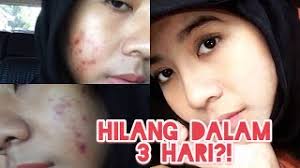 Masalah gatal dan alergi juga bisa diatasi dengan benoson cream sehingga satu tube benoson cream berfungsi untuk segala macam kebutuhan penyembuhan masalah kulit. Obat Apotik Yang Paling Ampuh Dan Cepat Menghilangkan Bekas Jerawat Pengalaman Pribadi Youtube