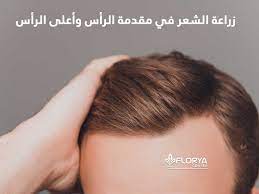 زراعة الشعر في مقدمة الرأس وأعلى الرأس تساقط الشعر غالبا ما يحدث للجميع وعملية زراعة الشعر في مقدمة الرأس وأعلى الرأس هي أمر شائع الحدوث جدا بين الرجال والنسا