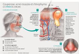 Les causes de l'acné sont multiples : Couperose Rosacee D Ou Viennent Ces Rougeurs Au Visage