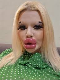 She has the world's biggest lips, and now wants huge cheekbones to match...  You had better sit down before you see how she looked before👇🏻👇🏻 Check  in comments...
