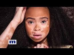 Age:37 years (29 april 1983). 19 Celebrities Who Talked About Their Vitiligo Openly Unite For Vitiligo