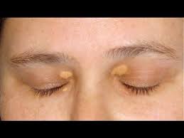How To Eliminate Cholesterol Deposits Around Your Eyes Easy And Naturally Youtube White Bump On Eyelid Bumps Under Eyes Spots In Eyes