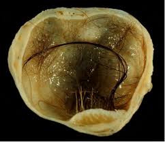 Thanks for the feedback thanks for the feedback. An Unusual Pelvic Mass In A 43 Year Old Woman Clinical Advisor