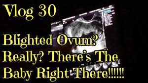 How long can a blighted ovum pregnancy last? Vlog 30 Blighted Ovum Really There S The Baby Right There Oct 3 2014 Youtube