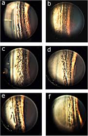 Image result for Gonioscopy