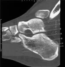 Image result for Calcaneus Compression Fracture