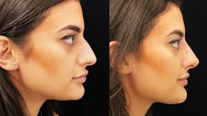 Description of facetouchup nose job simulator. I Got Surgery To Look Like My Selfie Filters